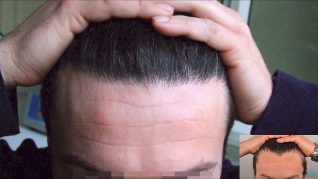ASMED Dr. Koray Erdogan, 2200 grafts. DES Manual FUE смотреть онлайн