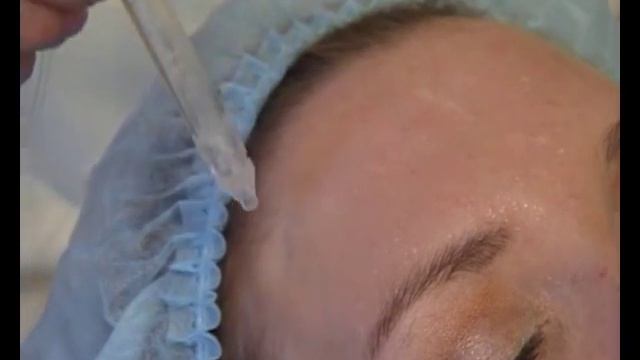 Jet Peel - безыньекционная мезотерапия смотреть онлайн