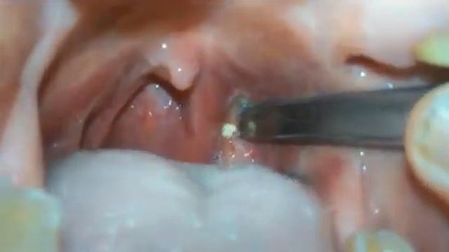 Хронические тонзиллит смотреть онлайн