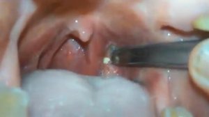 Хронические тонзиллит