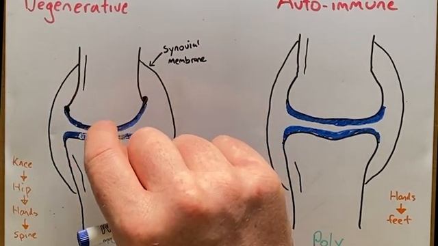 Osteoarthritis vs Rheumatoid arthritis in 2 mins! смотреть онлайн