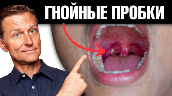 Как избавиться от гнойных пробок в горле навсегда?