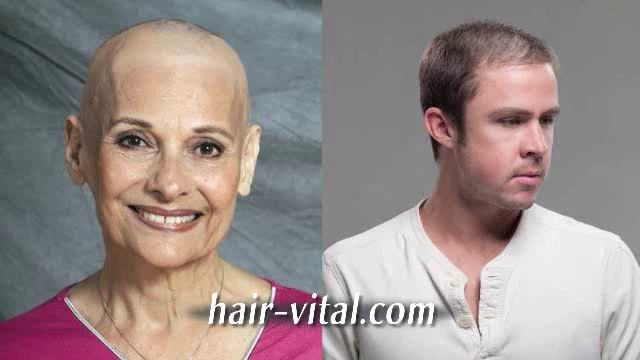 Hair Vital - Hair Restoration Solutions