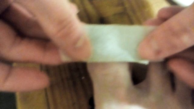 Травма ногтя. Гематома ногтя. Ушиб ногтя. Injury of the nail. Hematoma of the nail. Nail bruise. смотреть онлайн