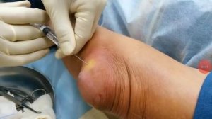 Удаление гноя подборка омерзительных вытаскивание