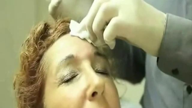 Омоложение и удаление морщин с помощью Ботокса смотреть онлайн