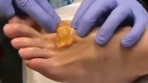 gigromani olib tashlash | удаление гигромы