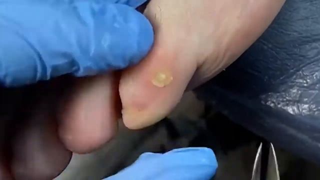 Удаление стержневой мозоли навсегда! #чеснок#мозоль#стержневаямозоль#механическоеудалениемозоли смотреть онлайн