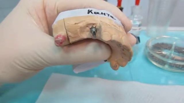 Пример сочетанного протезирования