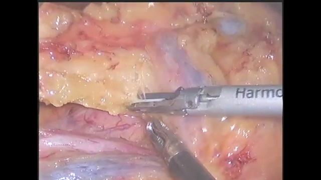 Laparoscopic complete mesocolic excision for central lymph node metastasis смотреть онлайн