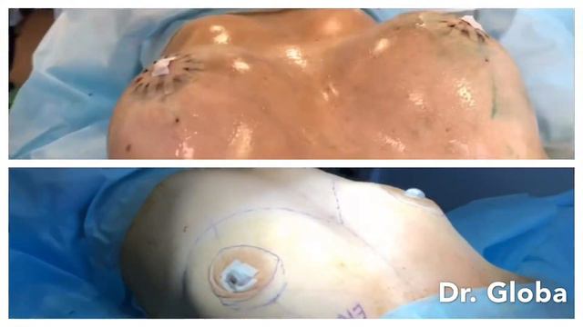 Увеличение молочных желёз Dr.Globa смотреть онлайн