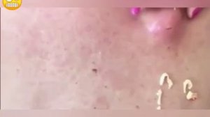 17.ДАВЛЮ ПРЫЩИ,УГРИ,ЖИРОВИКИ НА ЛИЦЕ!!!УДАЛЕНИЕ УГРЕЙ !