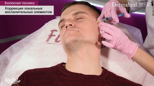 Коррекция локальных воспалительных элементов. Болюсная техника. Мезопрепарат - Dermaheal HSR