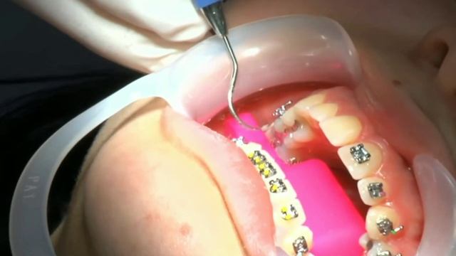 Braces . Dental Braces Timelapes