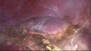 Лапароскопическая резекция печени с применением интраоперационного УЗ исследования у пациента 17 лет