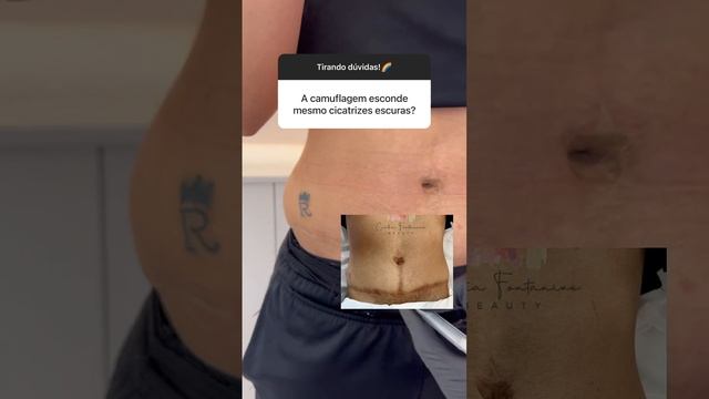 COBERTURA DE CICATRIZ INCRIVÉL- Cicatriz Cirúrgica - Funciona? смотреть онлайн