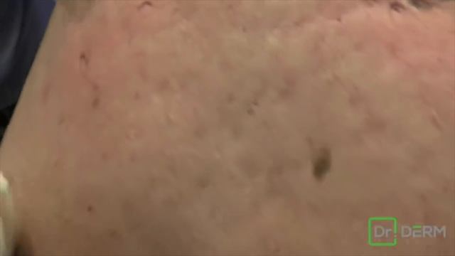 Minefield Of Blackheads (Throwback) | Dr. Derm