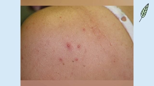 Фолликулит