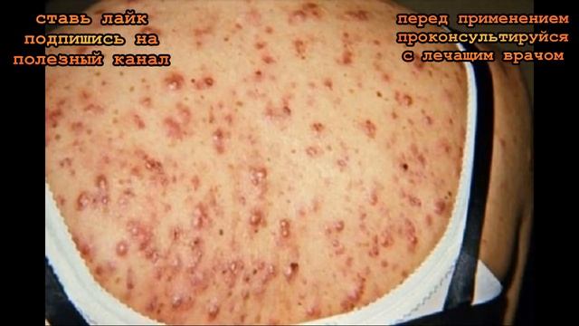 ★ Почему появляются ПРЫЩИ на разных частях тела. Будь внимателен! Это СИМПТОМЫ заболеваний. смотреть онлайн
