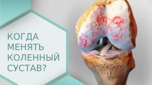 ? Нужно ли менять коленный сустав, и в каких случаях необходимо это делать? Менять сустав. 18+