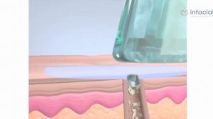 Процедура HydraFacial