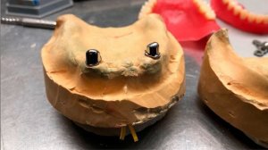 Съемные протезы на телескопических коронках