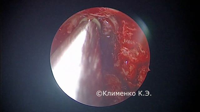 Расширенная эндоскопическая фронтотомия. Хронический фронтит после травмы. смотреть онлайн