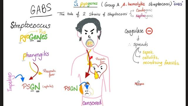 Sydenham Chorea (St. Vitus Dance) - Rheumatic Fever - Neurology & Cardiology смотреть онлайн