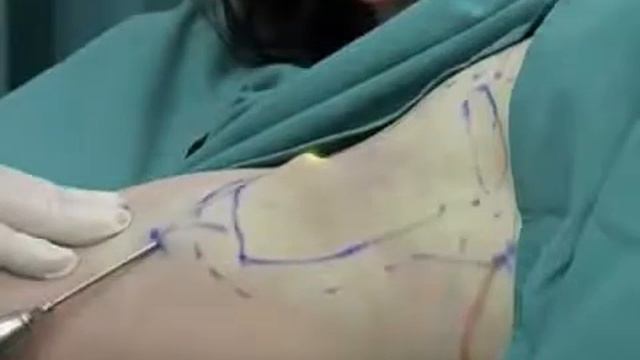 Lazernoe lechenie gipergidroza смотреть онлайн