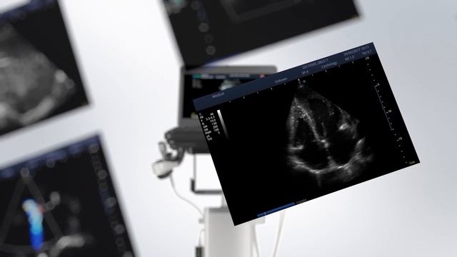 SonoScape X5 - laptop ultrasound system! смотреть онлайн