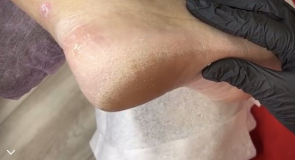 Обработка стоп