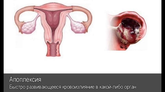 Апоплексия. Толковый Видеословарь русского языка смотреть онлайн