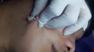 #2 Большая черная точка КАМЕДОН Большой жировик удаление черноголовых