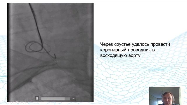 Случай закрытия псевдоаневризмы подключичной артерии смотреть онлайн