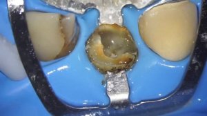 Восстановление зуба индивидуальной композитной вкладкой , лечение и протезирование зуба