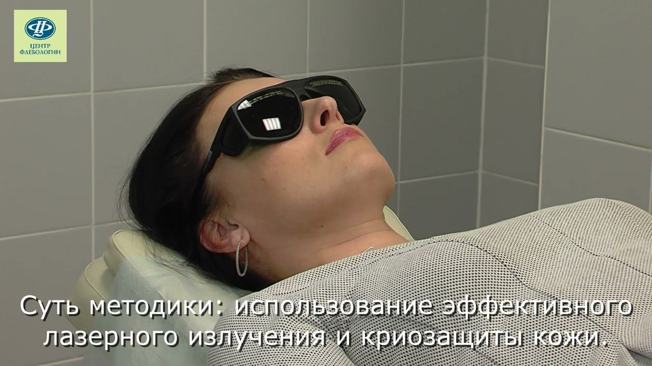 Лазерное удаление сосудов на ногах в Тюмени
