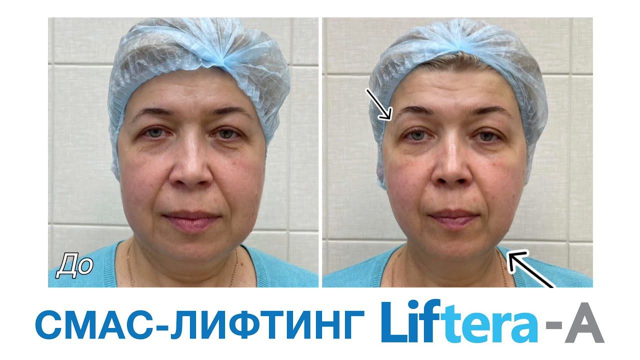 #смаслифтинг | Безоперационная ультразвуковая подтяжка лица смотреть онлайн