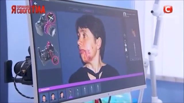 Я стесняюсь своего тела. СТБ. Удаление гемангиомы лазером