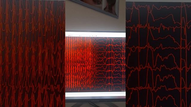 абсанс эпилепсия  нима?