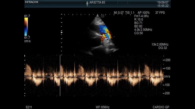 Dormed Hellas - ARIETTA 65 - Cardio PW-CW-TDI doppler смотреть онлайн