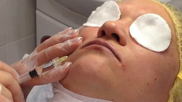 АирисКом: семинар филлеры, контурная пластика нижняя часть лица смотреть онлайн