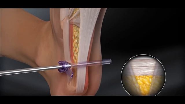 #Пяточная #шпора , она ли это или не она . #плантарный #фасциит#корешковый#ишиазплантырный смотреть онлайн