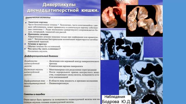 Дивертикулы желудочно кишечного тракта рентгенодиагностика, МСКТ смотреть онлайн