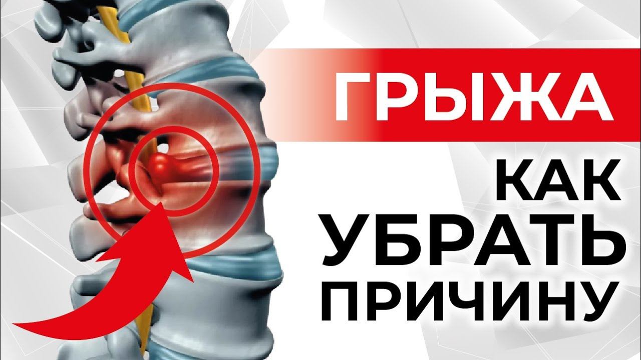 ГРЫЖА живота, межпозвоночная ГРЫЖА | Причины и лечение