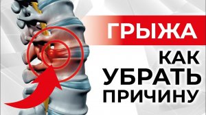 ГРЫЖА живота, межпозвоночная ГРЫЖА | Причины и лечение