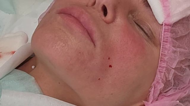 АирисКом студенты учатся: коррекция нижней части лица мезонитями. Линейные, спиральные, Cog.