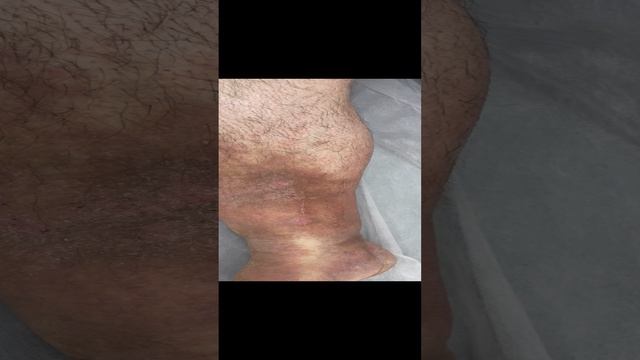 Трофические расстройства кожных покровов. Варикоза нет. Сосудистый хирург. Флеболог. Флеболог Москва смотреть онлайн