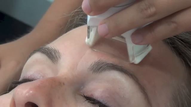 Tratamiento facial LPG Endermolift Antes y Después смотреть онлайн