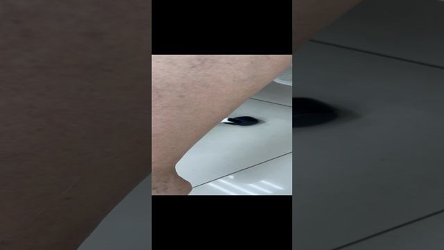 Сосудистая сетка. Наследственная предрасположенность. Лечение вен. Склеротерапия. Флеболог Москва смотреть онлайн