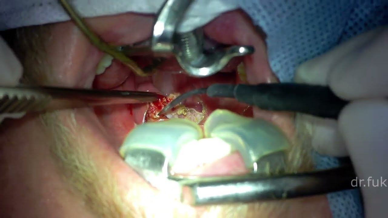 Хирургия храпа: палатопластика.  Храп и синдром обструктивного апноэ во сне эффективное лечение